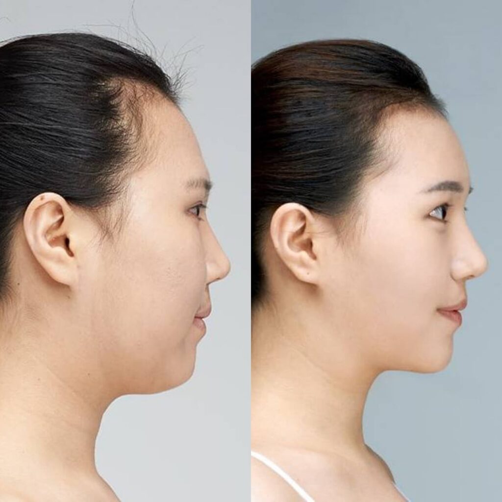 Asian Nose Refinement in Korea