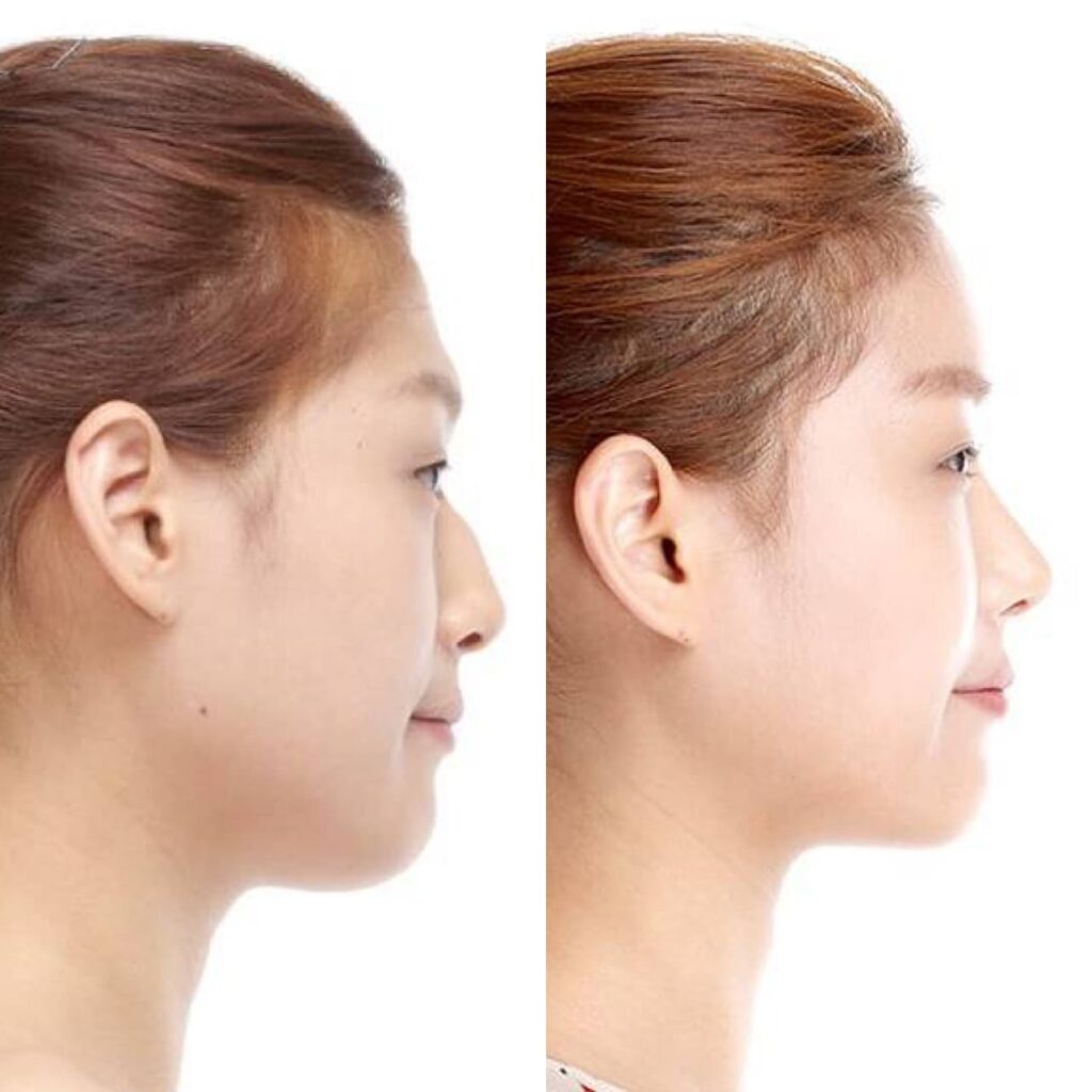 Asian Nose Trends in Korea