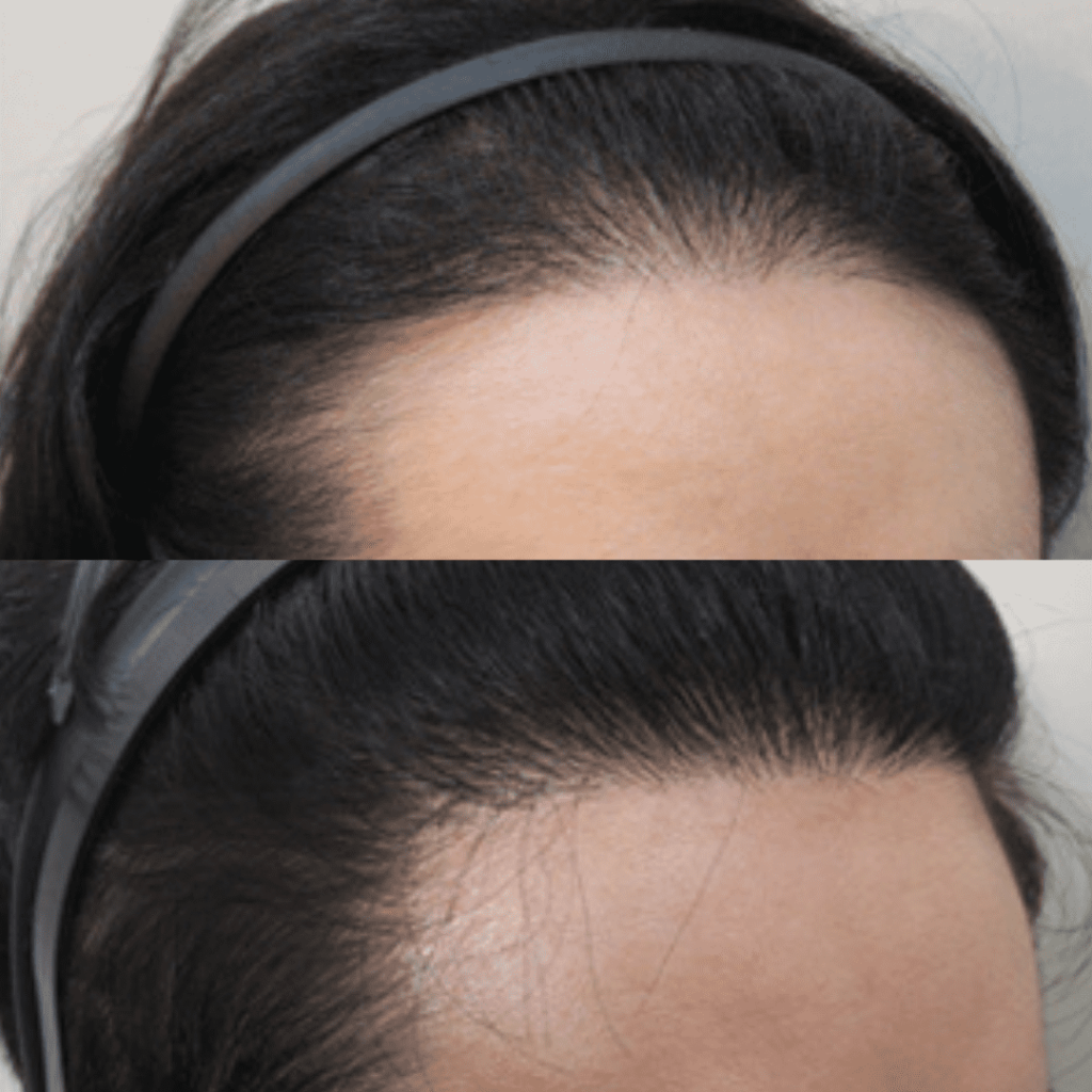 Assessing Candidacy for Hair Transplant Surgery in Korea