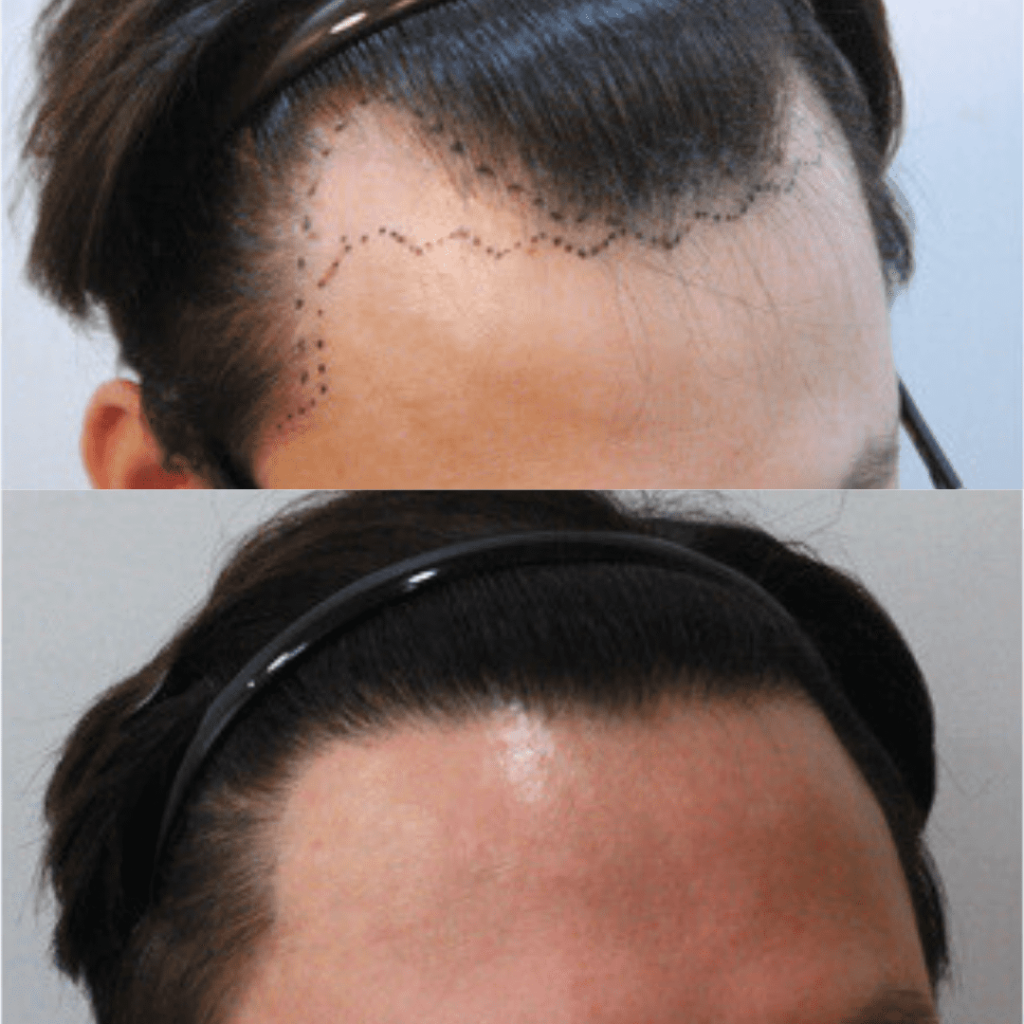 Assessing the Effectiveness of Hair Transplantation in Korea