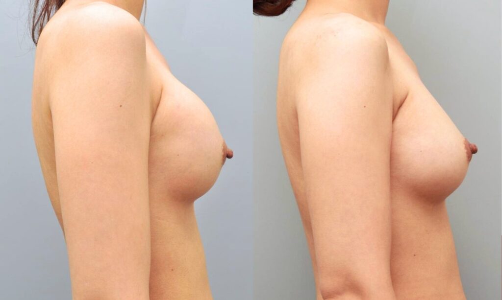 BREAST AUGMENTATION MOTIVA HIGH PROFILE 295CC