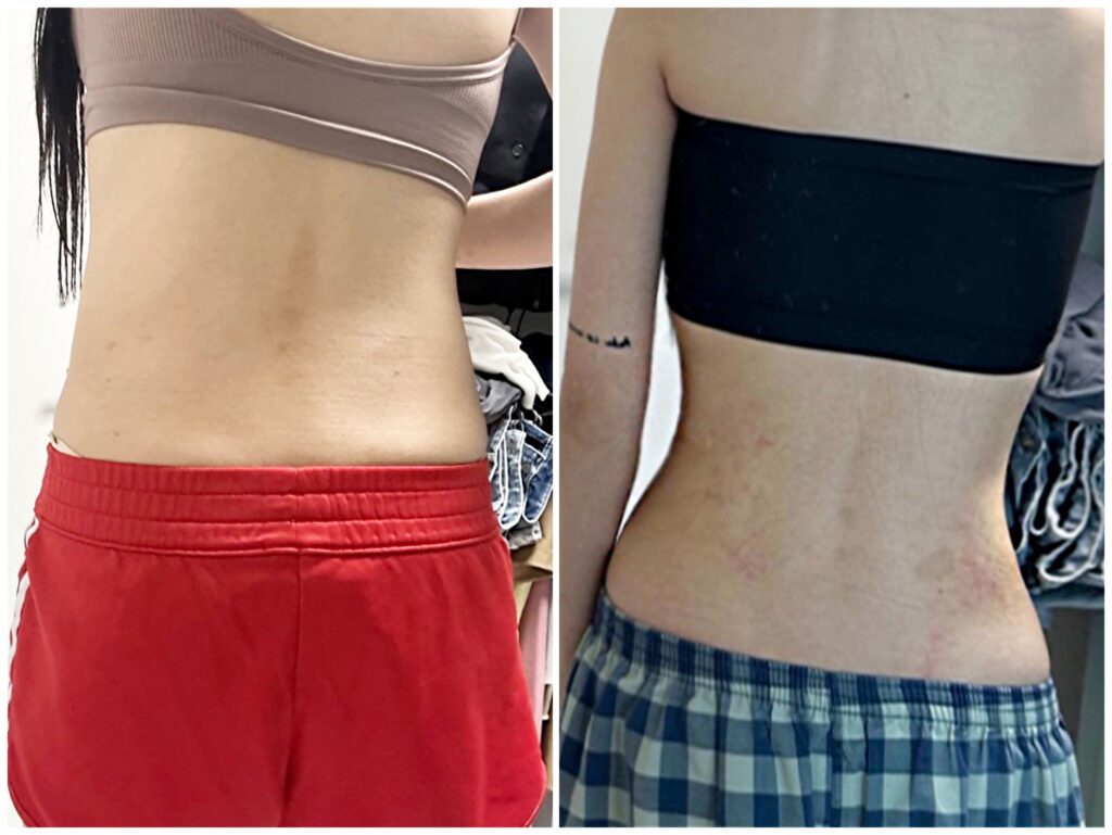 Back liposuction results