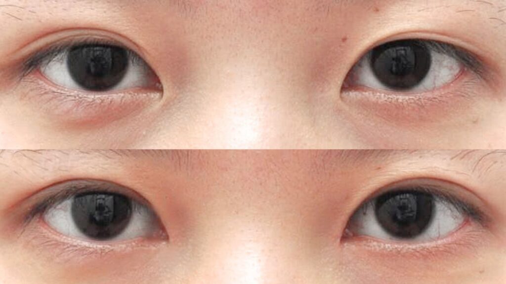 Beauty Unveiled_ Asian Blepharoplasty in Korea