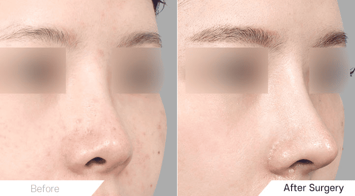 Beauty in Detail_ Rhinoplasty for Short Noses in Korea