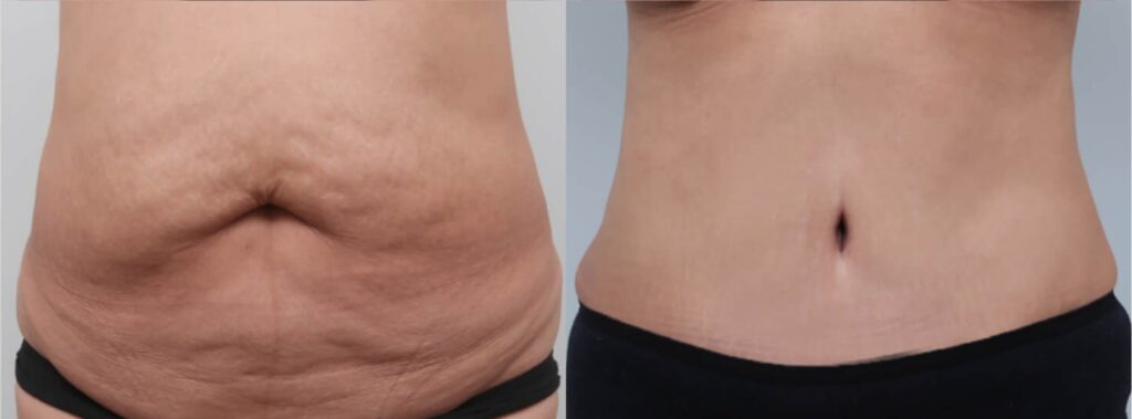 Before Abdominoplasty Surgery in Korea