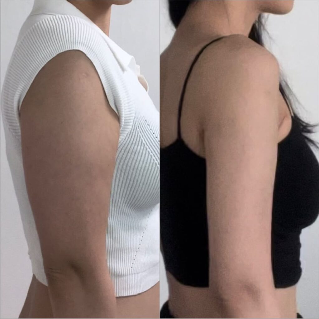 Before Arm Liposuction Surgery in Korea