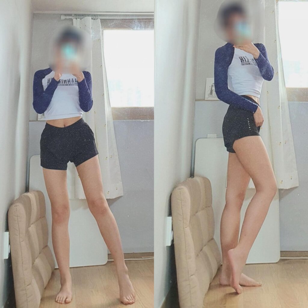 Before Leg Liposuction Surgery in Korea