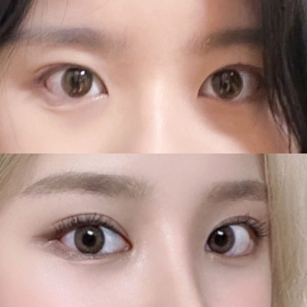 Before and After Canthoplasty in Korea