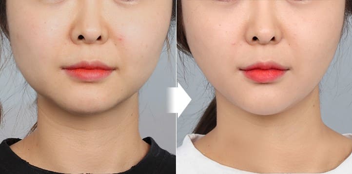 Before and After Face Lifting Procedures in South Korea