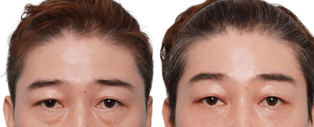 Before and After Forehead Lift Photos in Korea