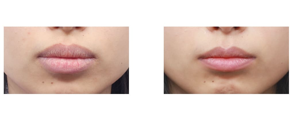 Before and After Lip Augmentation in Korea