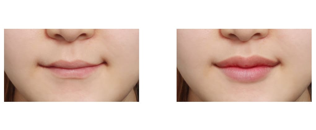 Before and After Lip Surgery Photos in Korea