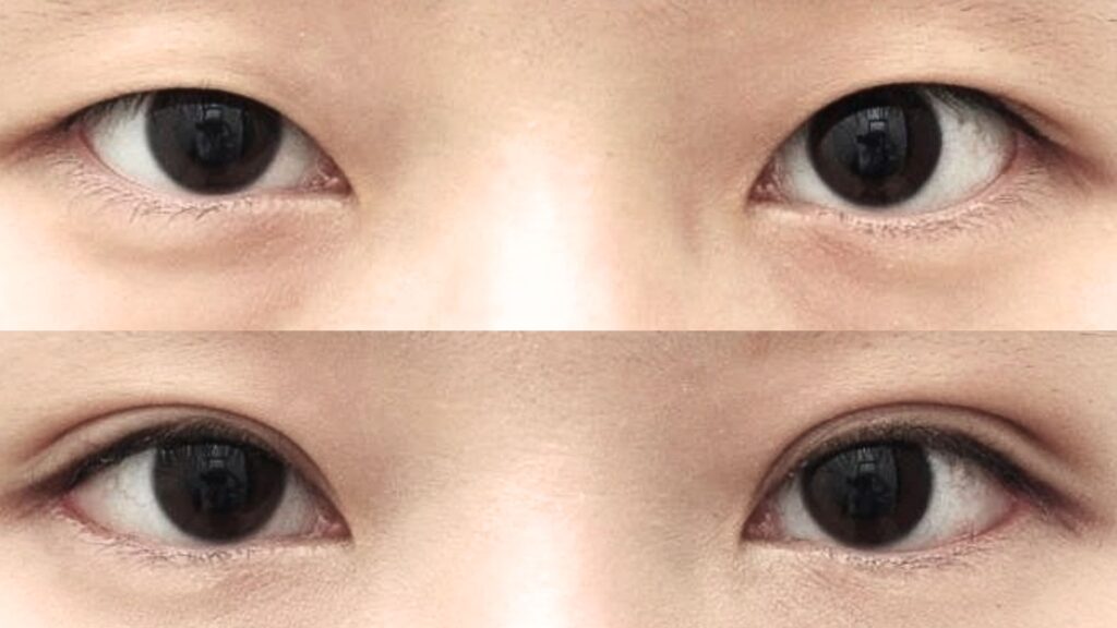 Before and After_ Effects of Asian Blepharoplasty in Korea