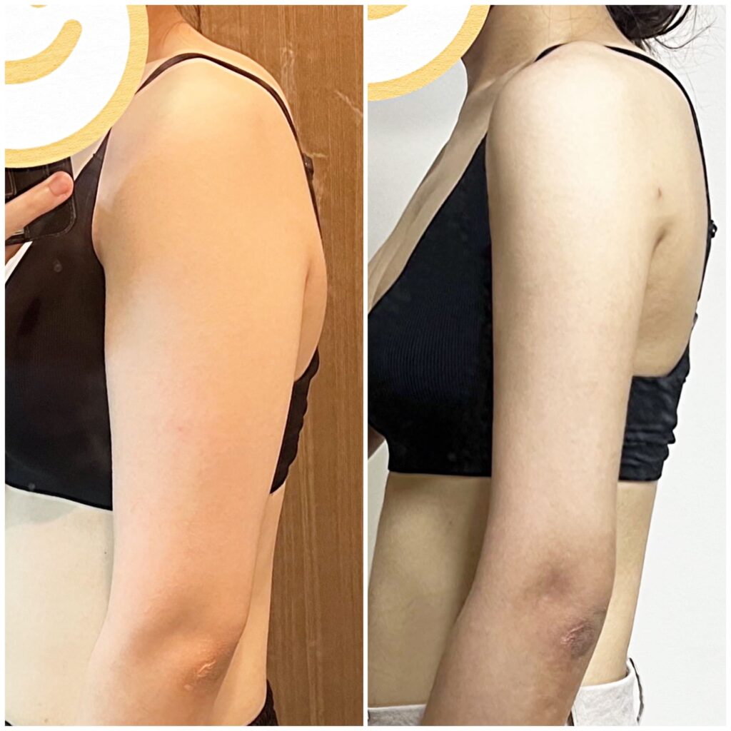 Benefits of Arm Liposuction Over Diets in Korea