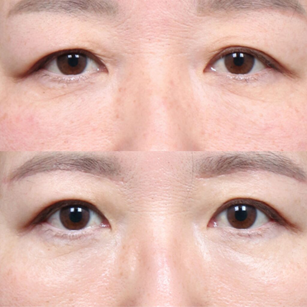 Benefits of Eyelid Lift in Korea