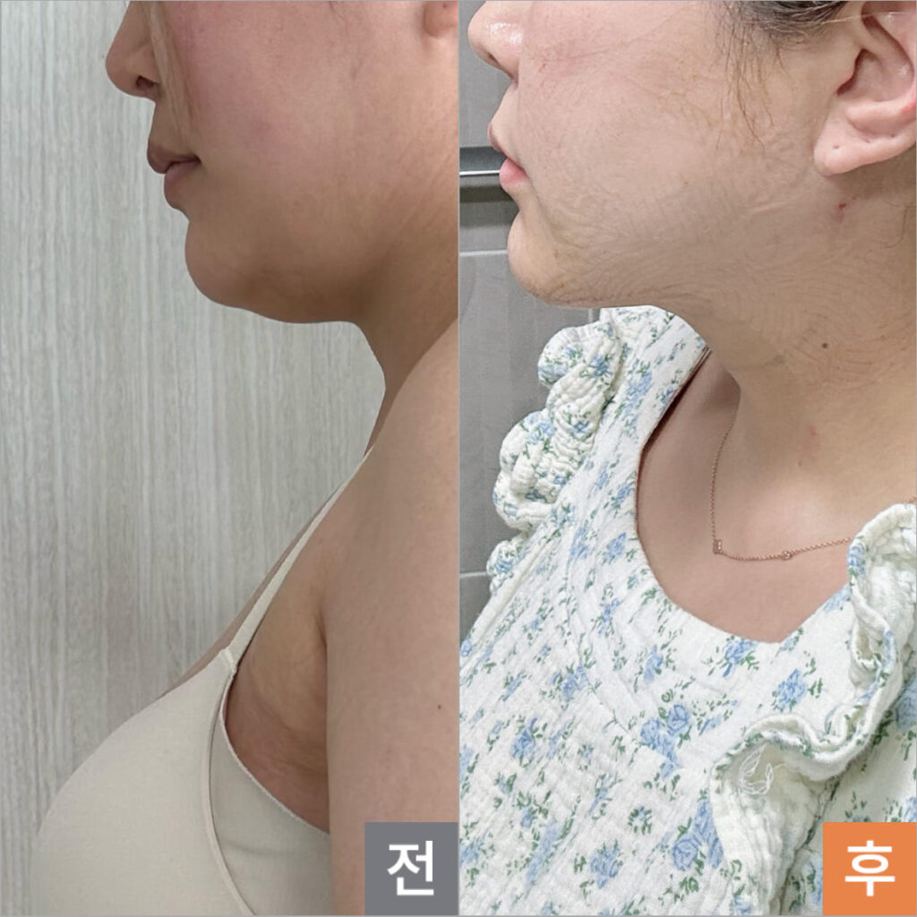 Benefits of Facial Liposuction in Korea