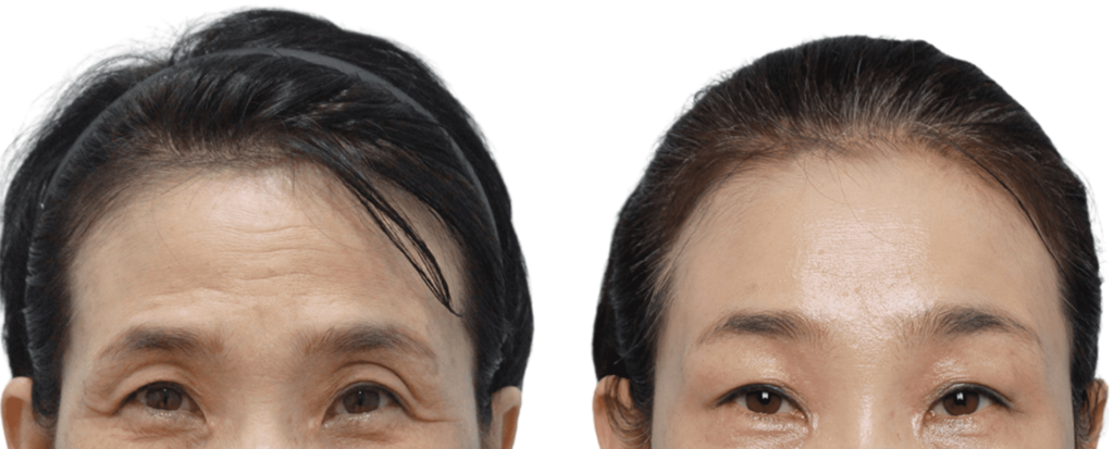 Benefits of Forehead Lift in Korea