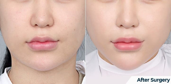 Benefits of Korean Face Lifting