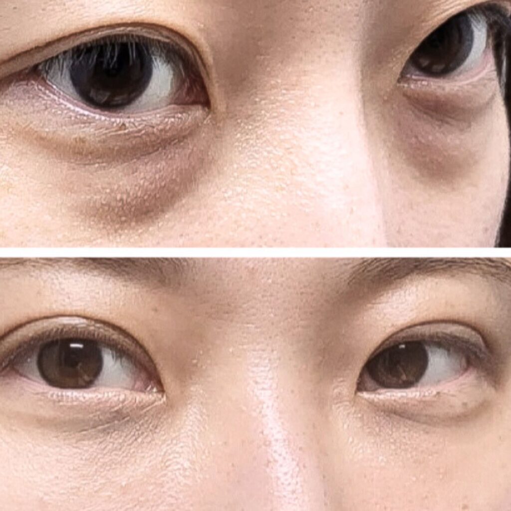 Benefits of Transconjunctival Blepharoplasty in Korea