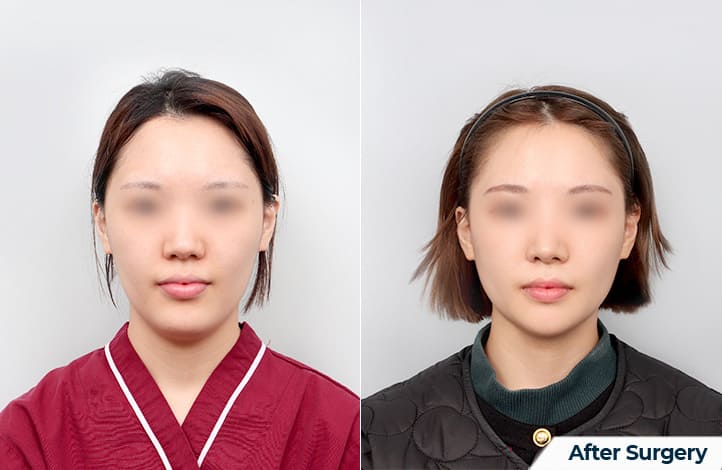 Benefits of V-line Correction Surgery in Korea