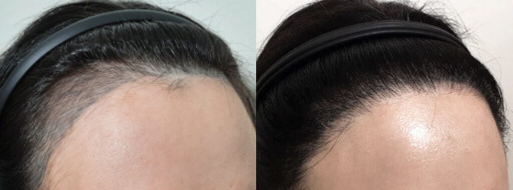 Benefits of hair transplant for women in Korea