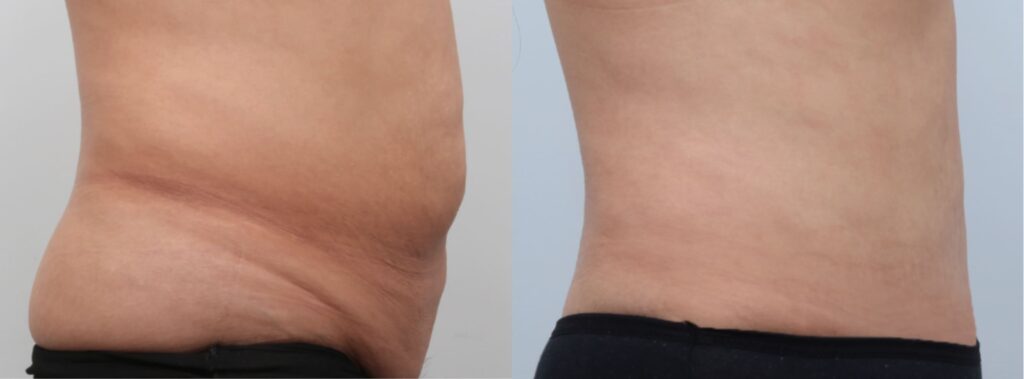 Best Abdominoplasty Clinics in Korea