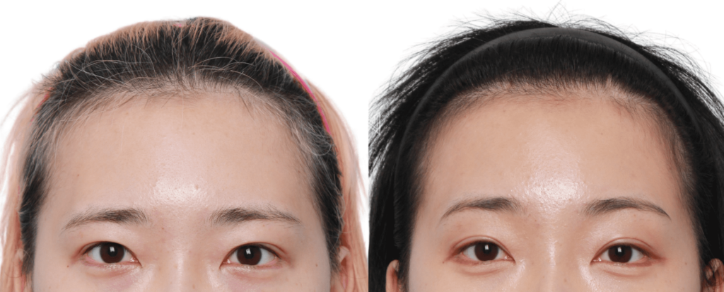 Best Clinics for Forehead Lift in Korea