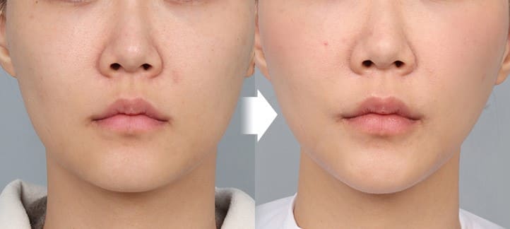 Best Practices for Face Lifting in Korea