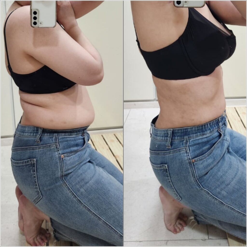 Best Techniques for Abdominal Liposuction in Korea