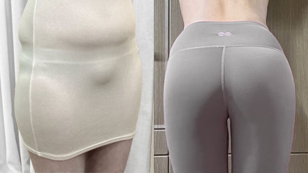 Best Techniques for Buttock Lipofilling in Korea