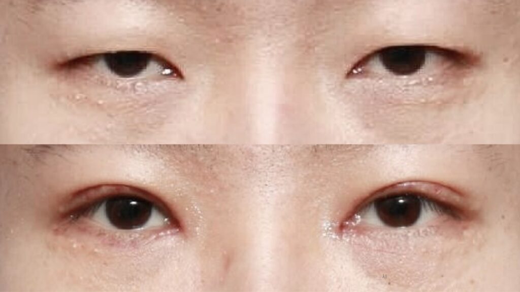 Blepharoplasty Results_ Amazing Transformations in Korea