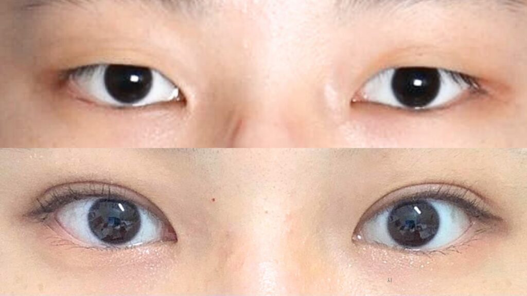 Blepharoplasty for Asian Eyes in Korea