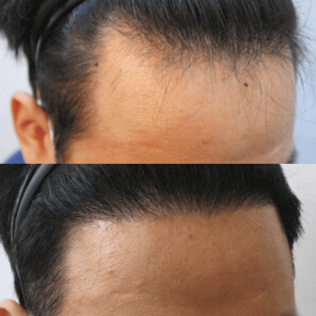 Boosting Confidence Through Hair Restoration in Korea