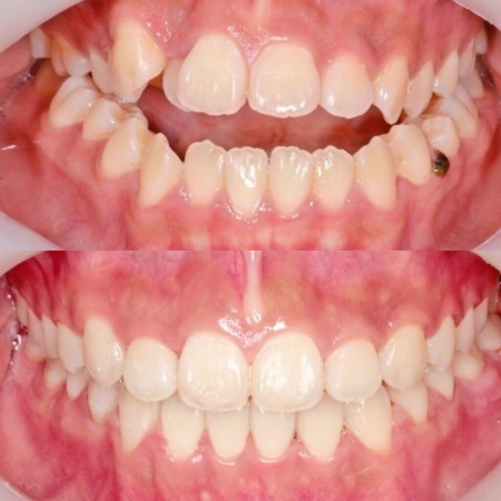 Braces before and after installation in Korea