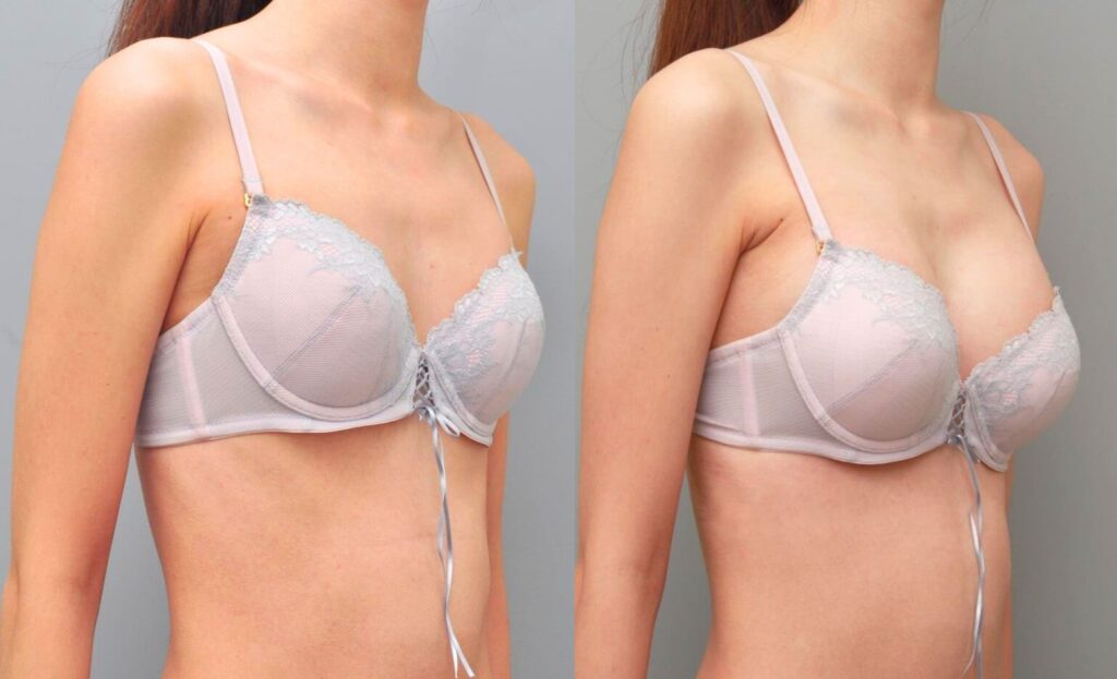 Breast Augmentation Sizing Consultation