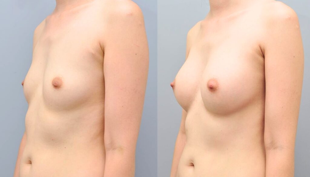 Breast Augmentation_ Before and After in Korea