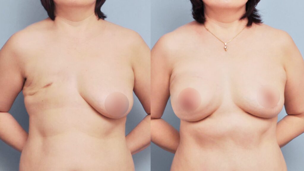 Breast Lift Combined with Reconstruction in Korea