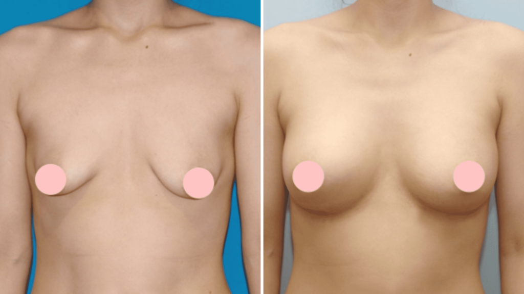 Breast Lift_ Before and After in Korea