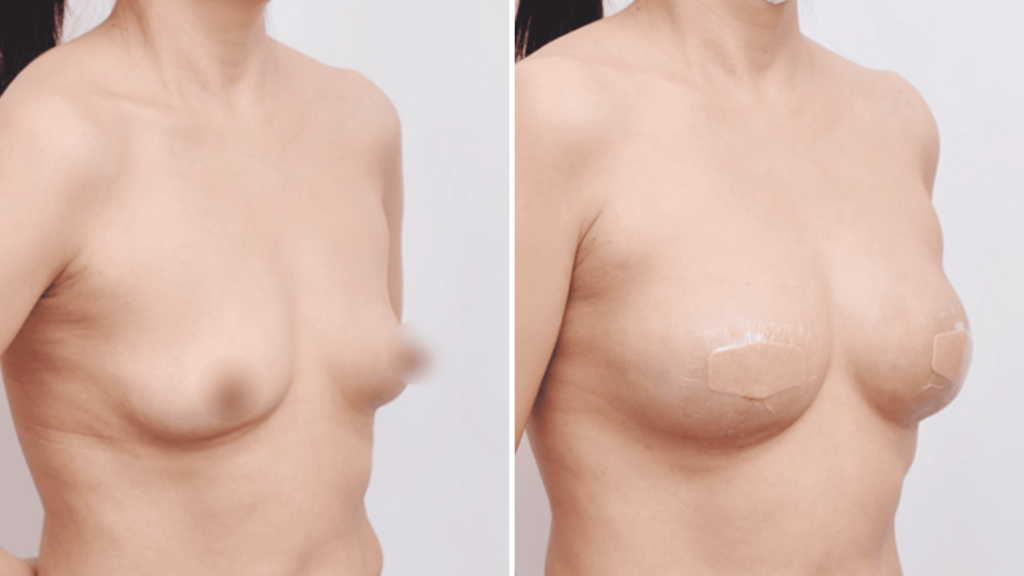 Breast Lipofilling_ Before and After in Korea