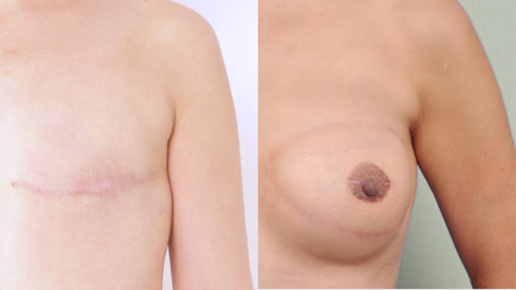 Breast Rebuilding after Mastectomy in Korea