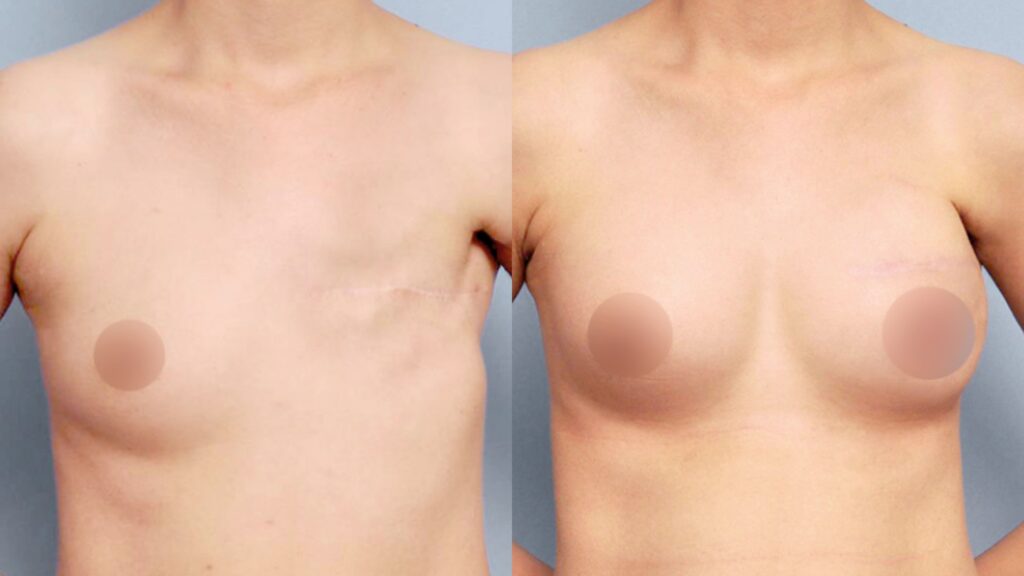 Breast Reconstruction with Motiva Implants in Korea