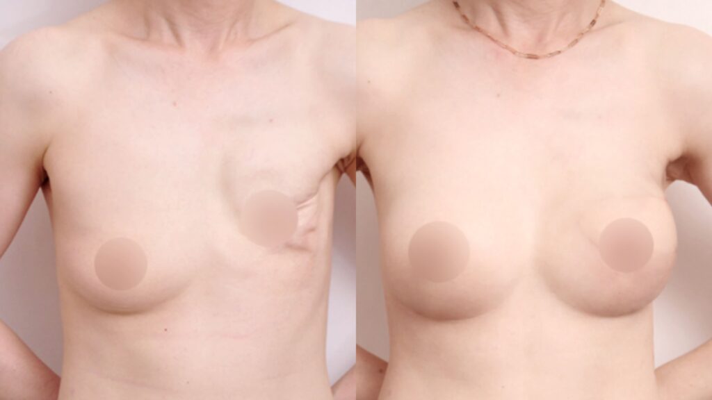 Breast Reconstruction_ Before and After in Korea