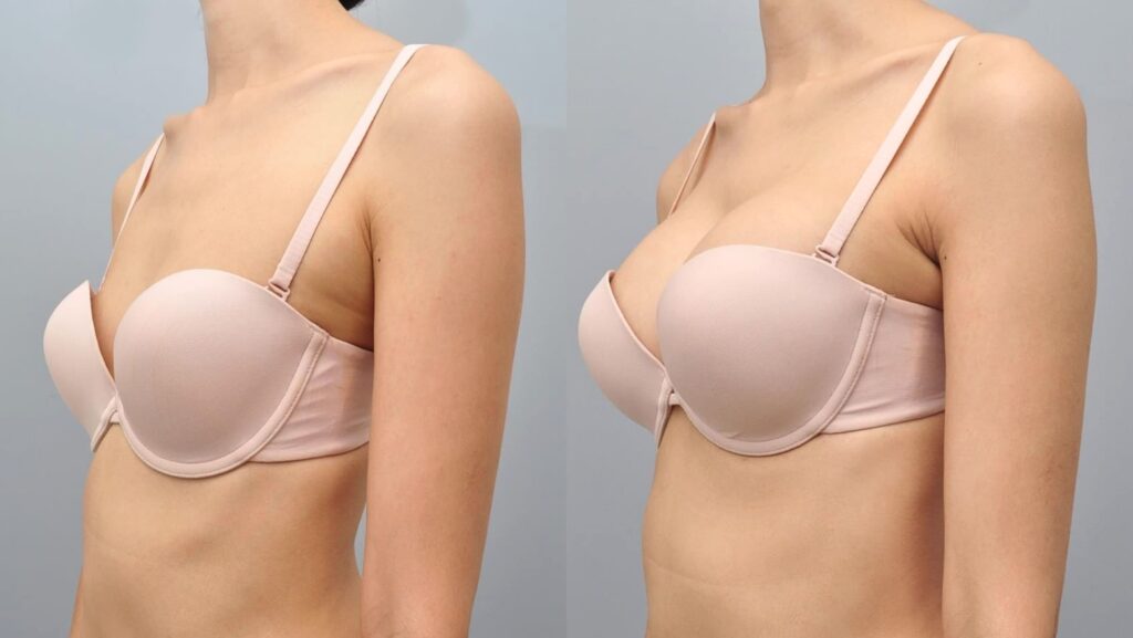 Breast Reduction Cost