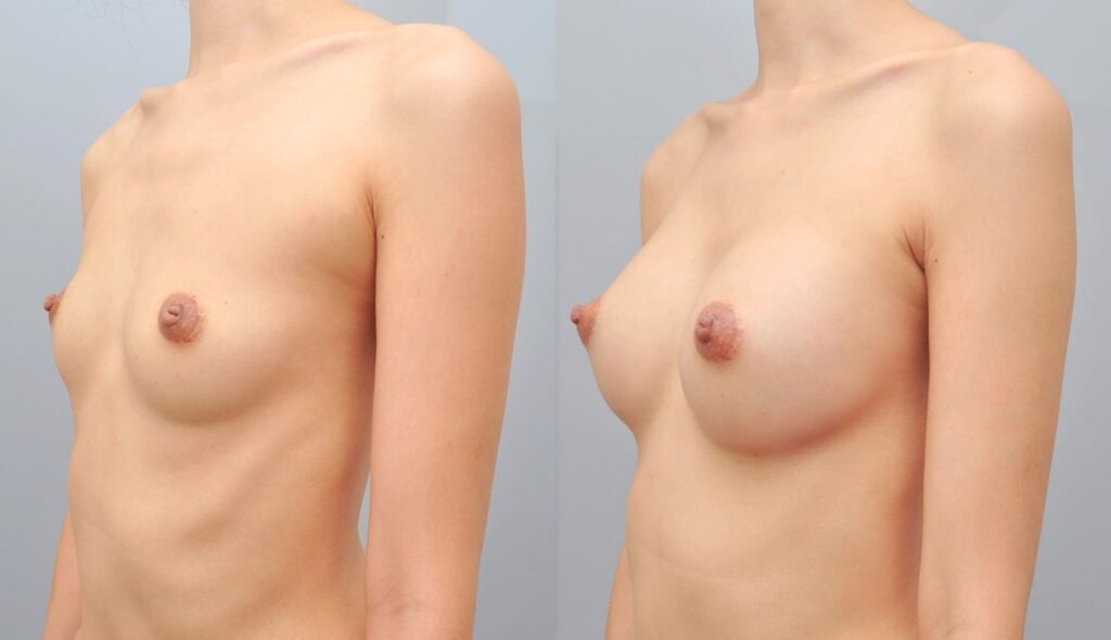 Breast Reduction Surgery