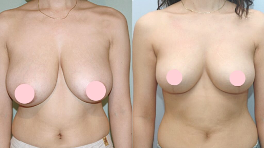 Breast Reduction_ Before and After