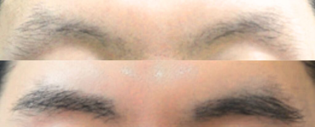 Brow Hair Transplant Process_ Step-by-Step