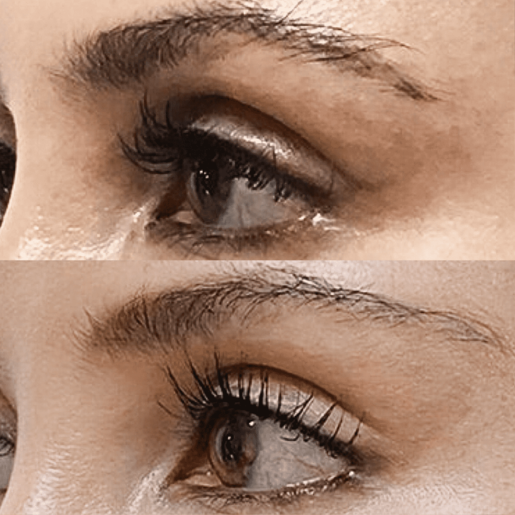 Brow Lifting before and after in Korea