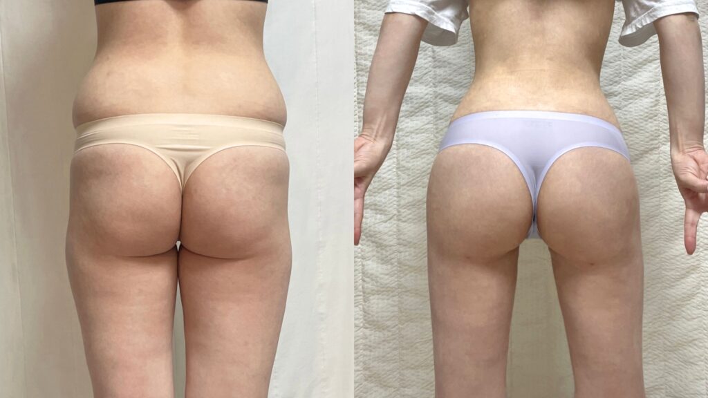 Buttock Asymmetry Correction via Lipofilling in Korea