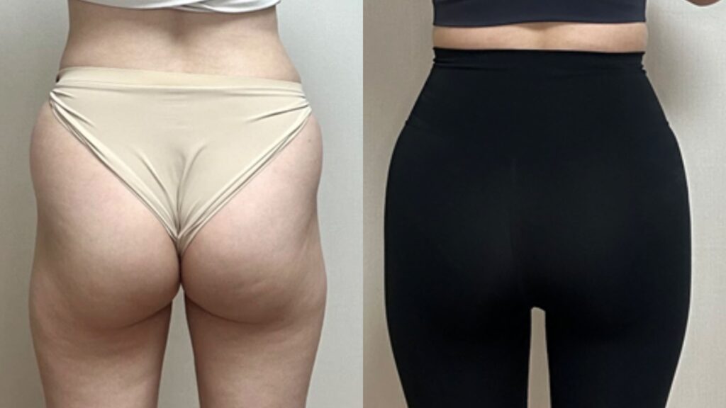 Buttock Lipofilling_ Long-Term Results in Korea