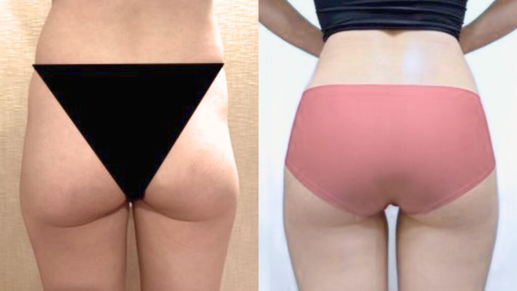 Buttock Lipofilling_ Patient Reviews in Korea